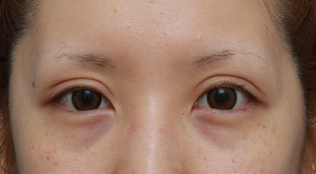 他院で受けた手術の修正(二重まぶた・目もと),他院で切開法で非常に幅の広い二重を作り失敗し、眼瞼下垂手術で幅を狭く修正した症例写真,4ヶ月後,目を開けた状態,mainpic_ganken11f.jpg