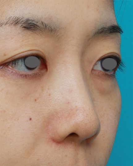 症例写真,鼻プロテーゼ+鼻尖形成+鼻翼(小鼻)縮小症例写真,After,ba_bisen17_b.jpg