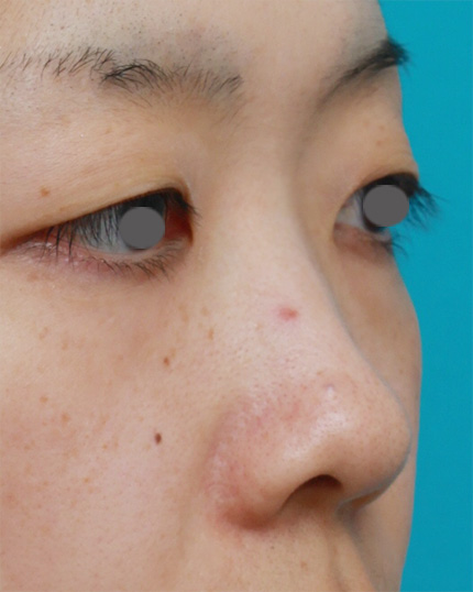 症例写真,鼻プロテーゼ+鼻尖形成+鼻翼(小鼻)縮小症例写真,Before,ba_bisen17_b.jpg