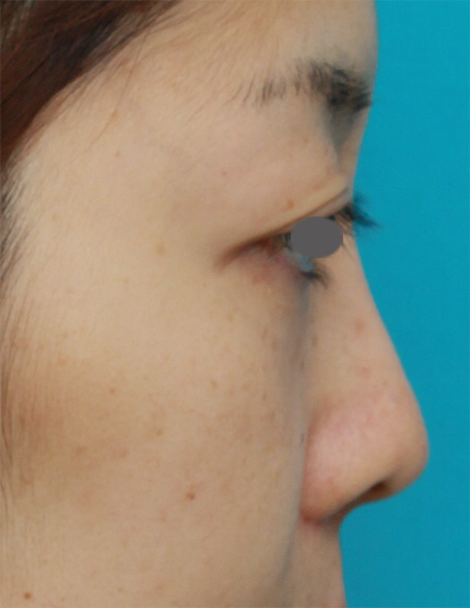 症例写真,鼻プロテーゼ+鼻尖形成+鼻翼(小鼻)縮小症例写真,After,ba_bisen18_b.jpg