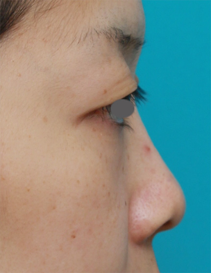 症例写真,鼻プロテーゼ+鼻尖形成+鼻翼(小鼻)縮小症例写真,Before,ba_bisen18_b.jpg