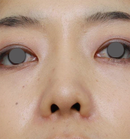症例写真,鼻プロテーゼ+鼻尖形成+鼻翼(小鼻)縮小症例写真,After,ba_bisen19_b.jpg