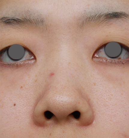 症例写真,鼻プロテーゼ+鼻尖形成+鼻翼(小鼻)縮小症例写真,Before,ba_bisen19_b.jpg