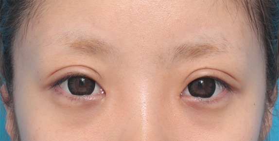 症例写真,目頭切開+眼瞼下垂手術で小さい目を大きくした症例写真,After(カラコンあり),