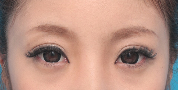 症例写真,目頭切開+眼瞼下垂手術で小さい目を大きくした症例写真,After(カラコン、メイクあり)<br/>
(6ヶ月後),