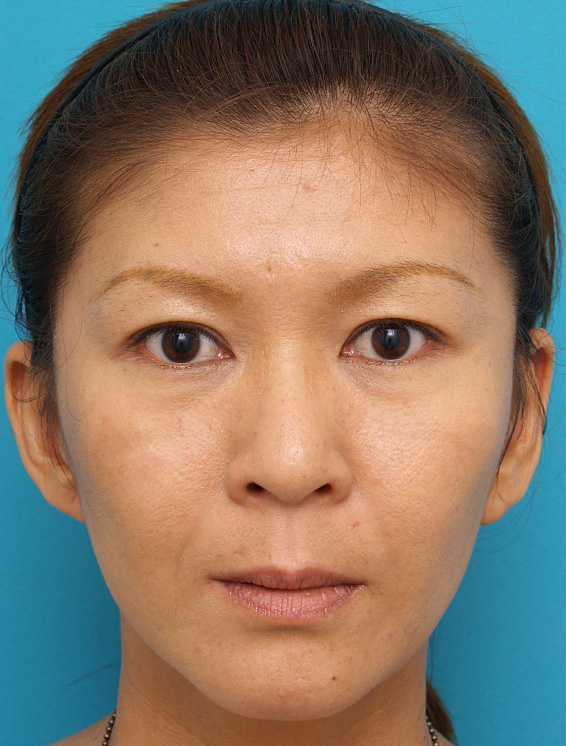 症例写真,ミディアムフェイスリフトの症例 顔のたるみを除去した女性,After(メイクあり)<br/>
(3ヶ月後),