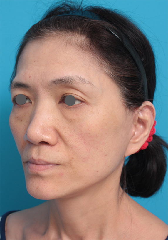 ゴルゴライン,50代女性に行ったミディアムフェイスリフト症例写真,After(2ヶ月後),ba_mediumlift_pic10_b.jpg