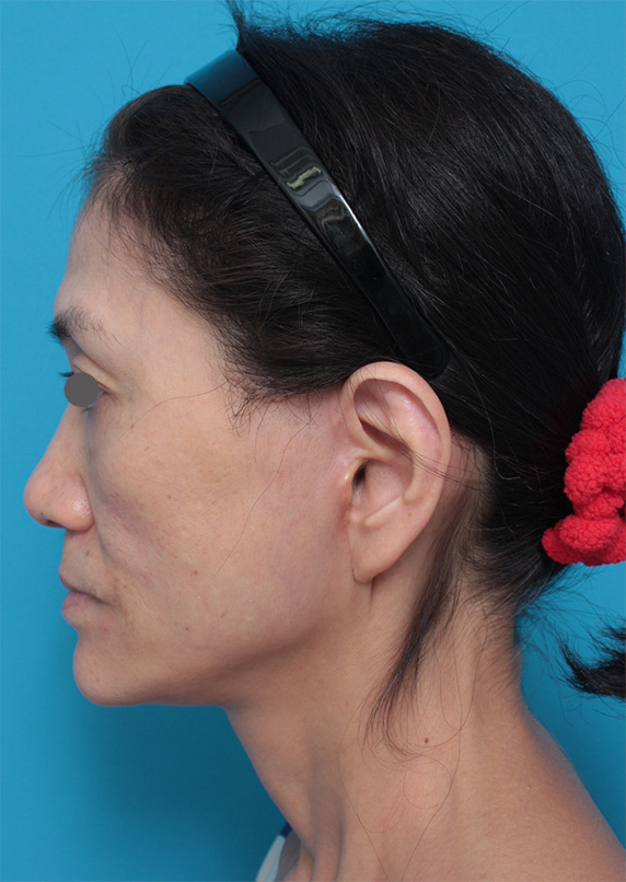 ゴルゴライン,50代女性に行ったミディアムフェイスリフト症例写真,After(2ヶ月後),ba_mediumlift_pic11_b.jpg