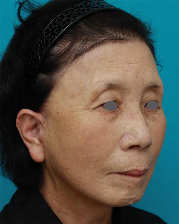 ミニフェイスリフト(頬のたるみ取り),60代女性に行ったミニフェイスリフト(頬のたるみ取り)の症例写真,After,ba_minilift19_b.jpg