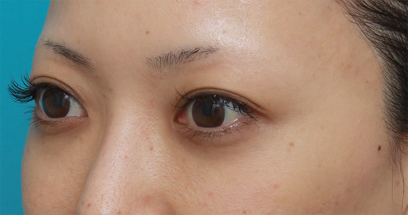 症例写真,他院で目の下に質の悪いヒアルロン酸を注射され凸凹になり、ヒアルロニダーゼで改善させた症例写真,After(1ヶ月後),ba_hyaluronjyokyo06_b.jpg