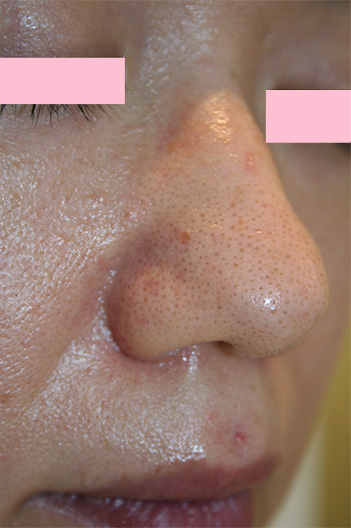 症例写真,フラクセル2の症例写真 鼻と鼻の周囲の毛穴の開きの治療,Before,ba_flaxel_pic21_b.jpg