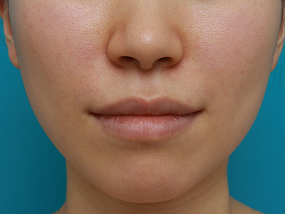 症例写真,20代前半の女性の法令線にヒアルロン酸注射した症例写真,After,ba_hyaluronic_pic33_b.jpg