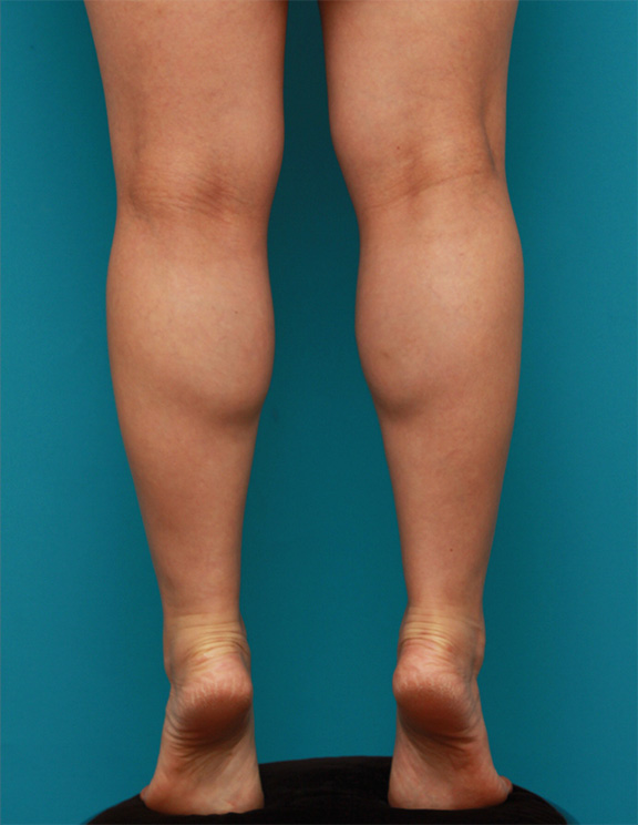 症例写真,ボツリヌストキシン注射(ふくらはぎ・足やせ・美脚)症例写真,Before,ba_leg_02_b.jpg
