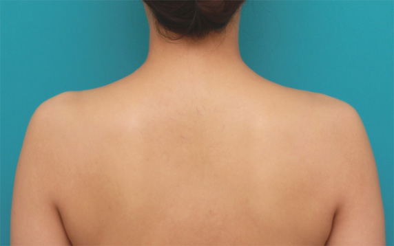 症例写真,ボツリヌストキシン注射(美人肩)でゴツい肩をすっきりさせ、肩凝りも改善した症例写真の術前術後画像,After(1ヶ月後),ba_shoulder_botox04_b.jpg
