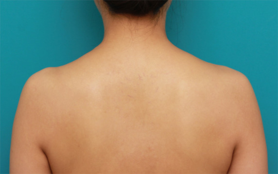 症例写真,ボツリヌストキシン注射(美人肩)でゴツい肩をすっきりさせ、肩凝りも改善した症例写真の術前術後画像,Before,ba_shoulder_botox04_b.jpg