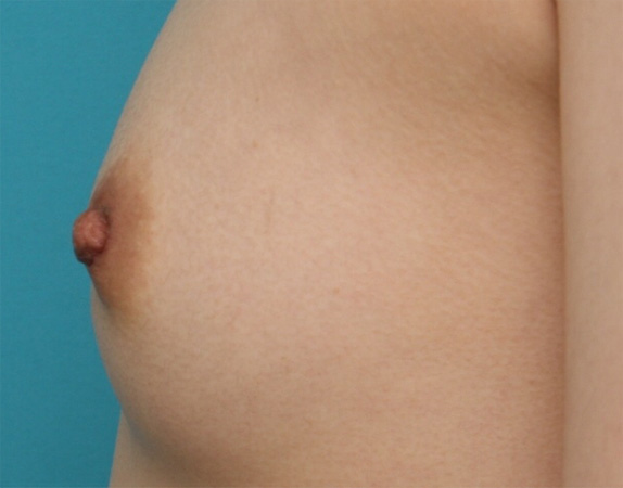 症例写真,乳頭縮小 妊娠、出産、授乳を繰り返し伸びてしまった乳首の症例,After(2週間後),ba_nyuto30_b.jpg