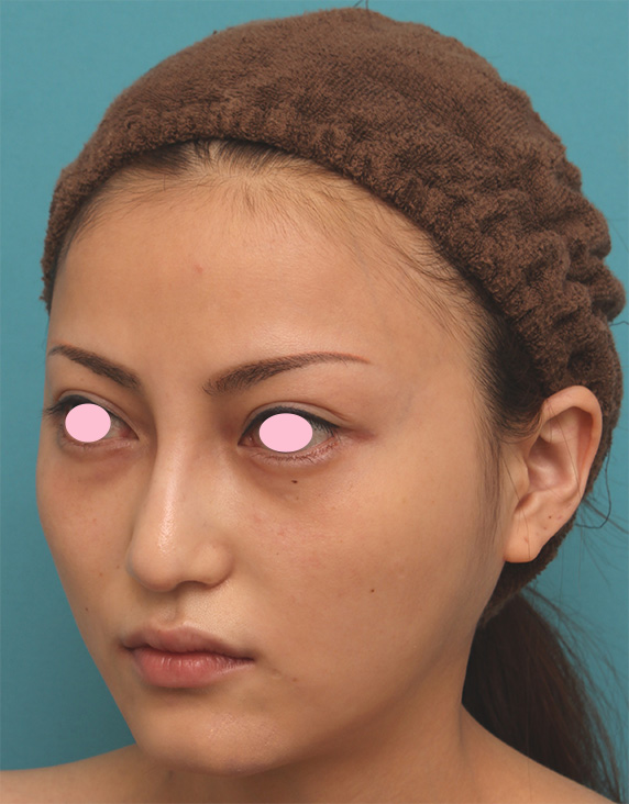 症例写真,狭くて平らなおでこに人工骨で額形成手術を行い、ぽっこり丸いおでこにした症例写真の術前術後画像,After(4ヶ月後),ba_meso_face04_b.jpg