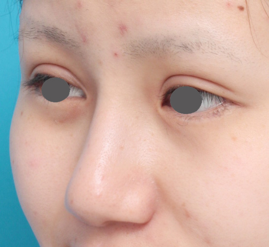 症例写真,鼻プロテーゼ+鼻尖形成(鼻尖縮小)症例写真,After(メイクなし),ba_ryubi36_b.jpg