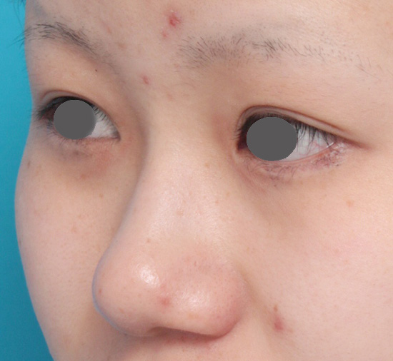 症例写真,鼻プロテーゼ+鼻尖形成(鼻尖縮小)症例写真,Before,ba_ryubi36_b.jpg