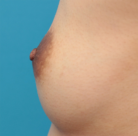 症例写真,乳頭縮小手術でやや大きめな乳首を小さめにした症例写真の術前術後画像,After(3ヶ月後),ba_nyuto32_b.jpg