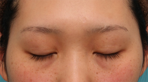 症例写真,目頭切開+二重まぶた全切開法で、幅が広すぎなく適度な狭さの平行型二重を作った症例写真の術前術後画像,After(目を閉じた状態),