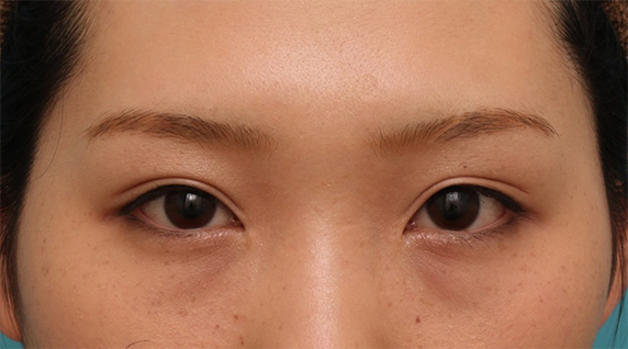 症例写真,目頭切開+二重まぶた全切開法で、幅が広すぎなく適度な狭さの平行型二重を作った症例写真の術前術後画像,After(メイクあり)<br/>
(6ヶ月後,