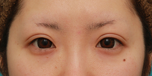 目頭切開,目頭切開+眼瞼下垂手術で、アイラインを引いても奥二重のようにならない幅のある平行型二重を作った症例写真の術前術後画像,After(カラコンあり),