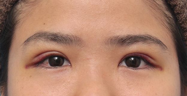 症例写真,二重まぶた埋没法と同じラインで全切開法をした症例写真の術前術後画像,6日後,mainpic_sekkai34c.jpg