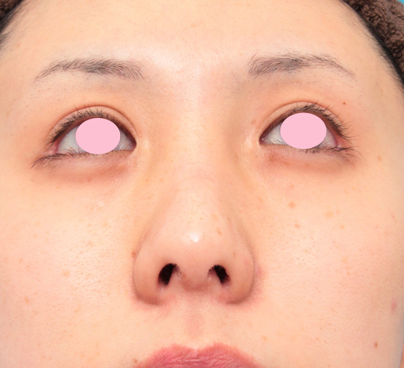 症例写真,鼻骨切り幅寄せと小鼻縮小手術をした症例写真の術前術後画像,After(6ヶ月後),ba_honekiri007_b02.jpg