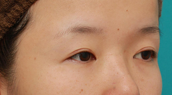 目頭切開,眼球自体が小さく開きも悪い目に対して、目頭切開+眼瞼下垂手術で目を一回り大きくした症例写真,After(6ヶ月後),ba_megashira047_b02.jpg