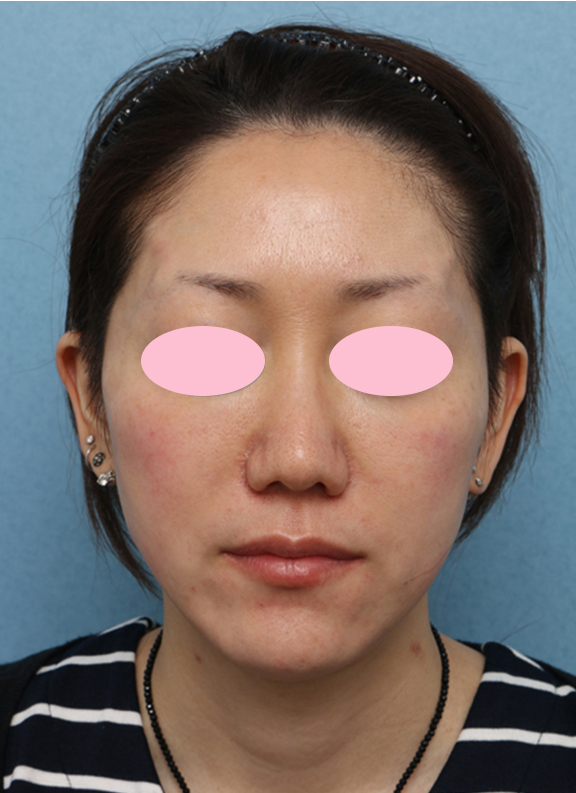 症例写真,Vシェイプリフト(ヒアルロン酸注射)の症例 両頬をリフトアップしたい女性,After,ba_v_shapelift004_b01.jpg