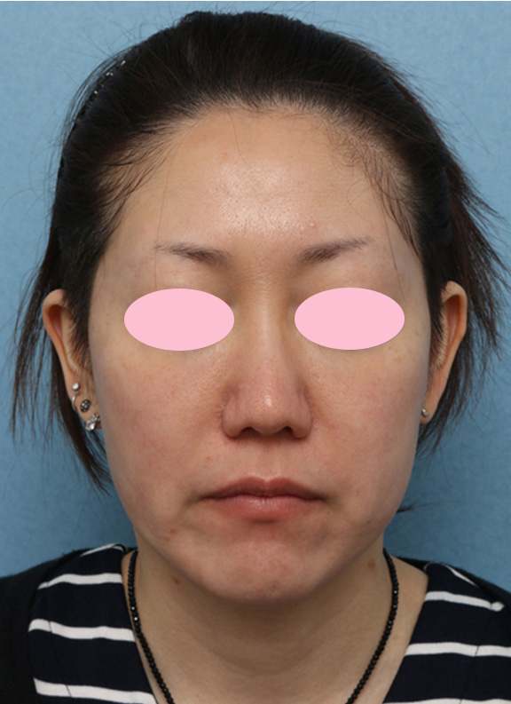 症例写真,Vシェイプリフト(ヒアルロン酸注射)の症例 両頬をリフトアップしたい女性,Before,ba_v_shapelift004_b01.jpg