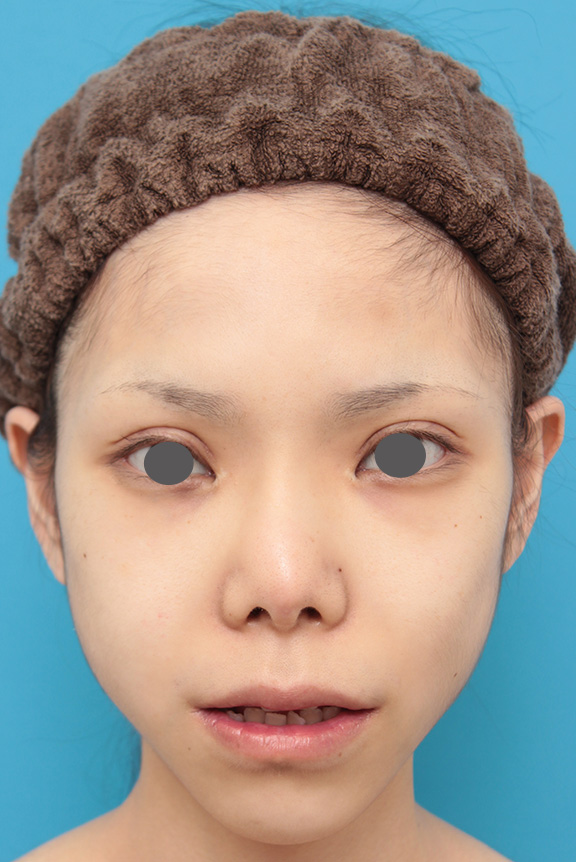 症例写真,上下の厚い唇を手術で程よく薄くした症例写真,After(8ヶ月後),ba_usuku007_b02.jpg