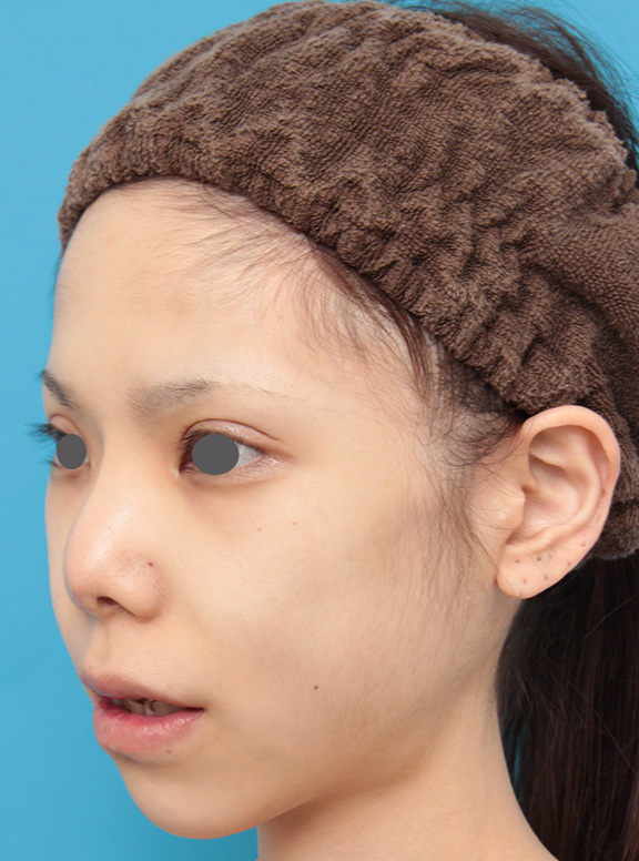 症例写真,上下の厚い唇を手術で程よく薄くした症例写真,After(8ヶ月後),ba_usuku007_b04.jpg