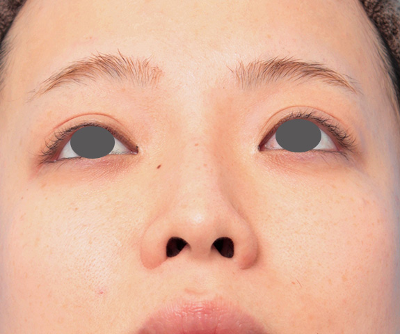 症例写真,鼻プロテーゼと耳介軟骨移植と小鼻縮小を同時に行った症例写真,After(9ヶ月後),ba_ryubi1035_b02.jpg