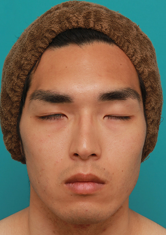 症例写真,片目の先天性眼瞼下垂を筋膜吊り上げで手術した症例写真,After(6ヶ月後の目を閉じた状態),