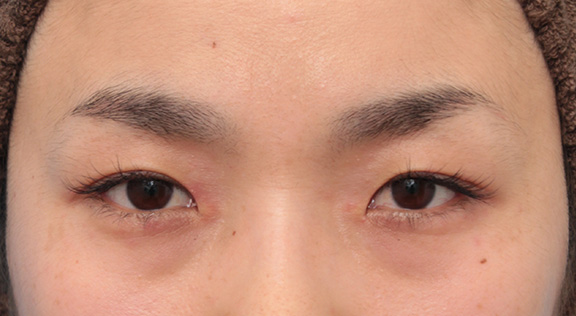 目頭切開,目頭切開で蒙古襞の突っ張りをとり、目を内側に広げた30代女性の症例写真,Before,ba_megashira049_b01.jpg