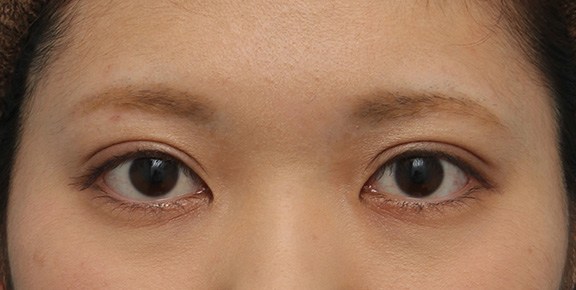 症例写真,二重まぶた全切開法でやや幅の広い平行型二重を作った症例写真,After(1年3ヶ月後のメイクありの状態),