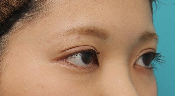 症例写真,二重まぶた全切開法でやや幅の広い平行型二重を作った症例写真,After(1年3ヶ月後のメイクありの状態),