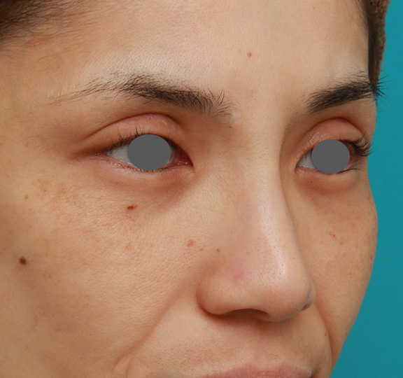 症例写真,患者様の希望で眉間から鼻根部にかけてヒアルロン酸を注射し、ギリシャ人のようになった症例写真,After(1ヶ月後),ba_ryubi2028_b02.jpg