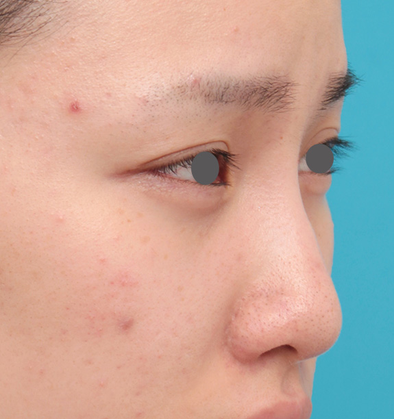症例写真,他院で受けた手術の修正(鼻)の症例 エンドプロテーゼ除去/シリコンプロテーゼ挿入,After(6ヶ月後),ba_nose_modify018_b02.jpg
