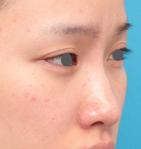 症例写真,他院で受けた手術の修正(鼻)の症例 エンドプロテーゼ除去/シリコンプロテーゼ挿入,Before,ba_nose_modify018_b02.jpg