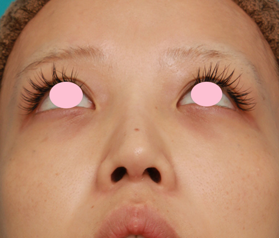症例写真,他院で受けた鼻中隔延長手術の修正手術の症例写真,After(修正手術後4ヶ月),ba_nose_modify019_b04.jpg