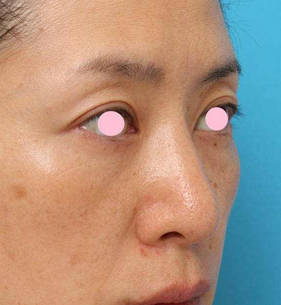 症例写真,骨切り幅寄せ手術で鼻の横幅を小さくした40代女性の症例写真,After(6ヶ月後),ba_honekiri009_b02.jpg