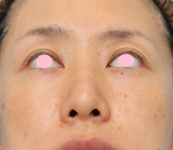 症例写真,骨切り幅寄せ手術で鼻の横幅を小さくした40代女性の症例写真,After(6ヶ月後),ba_honekiri009_b04.jpg