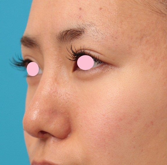 症例写真,他院で受けた鼻中隔延長+ゴアテックスの修正手術の症例写真,After(修正手術後1年),ba_nose_modify020_b02.jpg