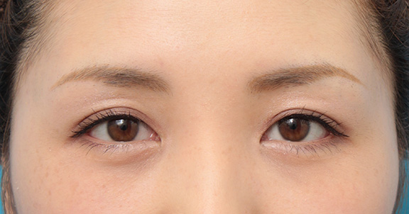目頭切開,目頭切開で、平行型二重のまま目を内側に広げた症例写真,After(6ヶ月後メイクあり),