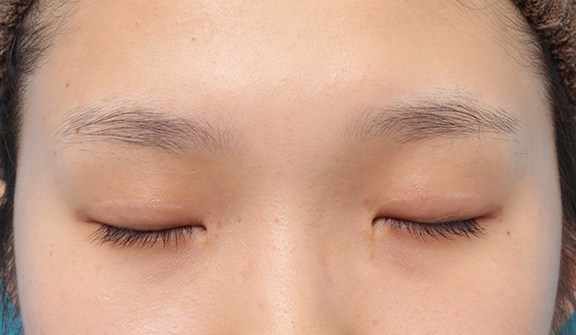 目頭切開,目頭切開、眼瞼下垂手術、タレ目形成を同時に行った症例写真,After(6ヶ月後の目を閉じた状態),