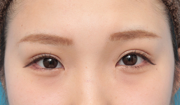 目頭切開,目頭切開、眼瞼下垂手術、タレ目形成を同時に行った症例写真,After(6ヶ月後メイクあり),