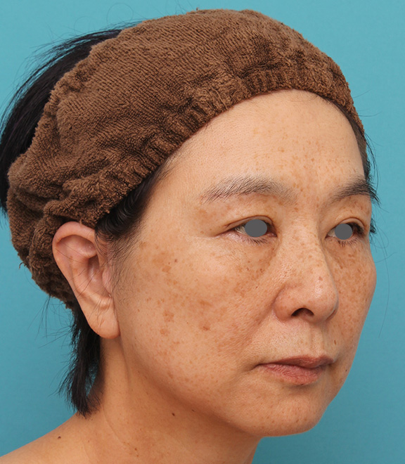 症例写真,ミディアムフェイスリフトで頬のたるみをリフトアップさせた50代後半女性の症例写真,After(6ヶ月後),ba_mediumlift008_b02.jpg